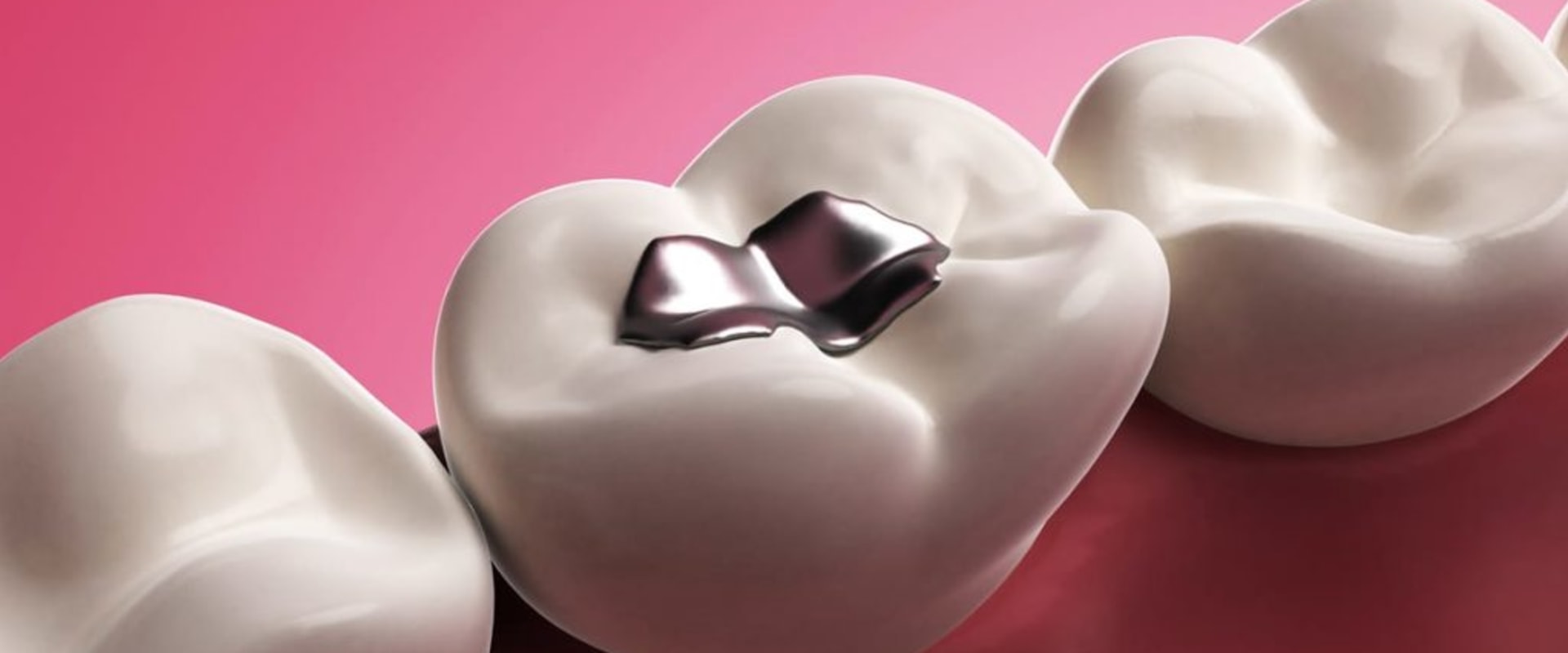 What kind of filling lasts the longest?