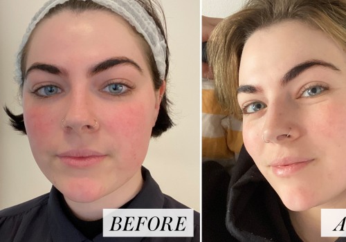 Skin Savvy USA: Conceals Skin Aging Through Facial Fillers