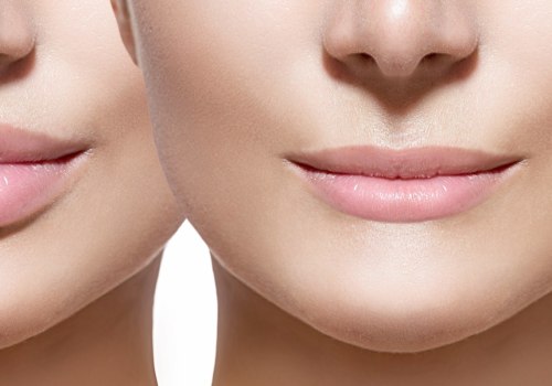 Can Dermal Fillers Cause Lymphoma?