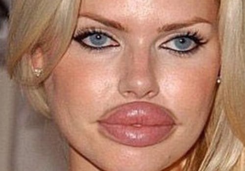 The Fascinating History of Facial Fillers