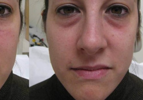What is the Safest Filler for the Face?