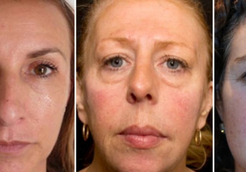 Why Fillers Make People Look Older