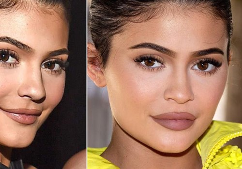 What Causes Fillers to Dissolve: An Expert's Perspective