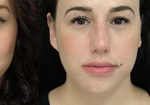 Which Facial Filler Lasts the Longest?