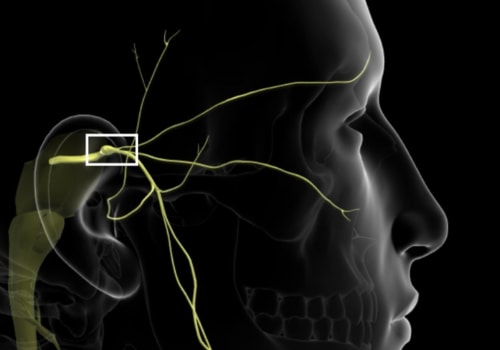 What Causes the Outbreak of Trigeminal Neuralgia?